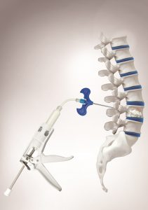 Spinal stenosis device, Epidurolysis procedure