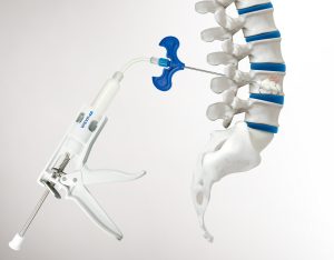 Spinal stenosis device, Kyphoplasty system