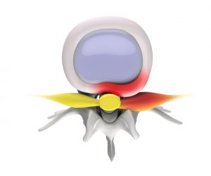 Spinal stenosis device, Epidurolysis procedure