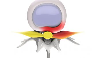 Spinal stenosis device, Epidurolysis procedure